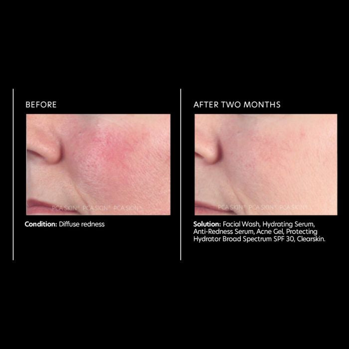 PCA Skin Anti- Redness Seru