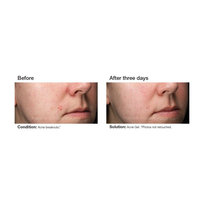 PCA Skin Acne Gel with Omnisome