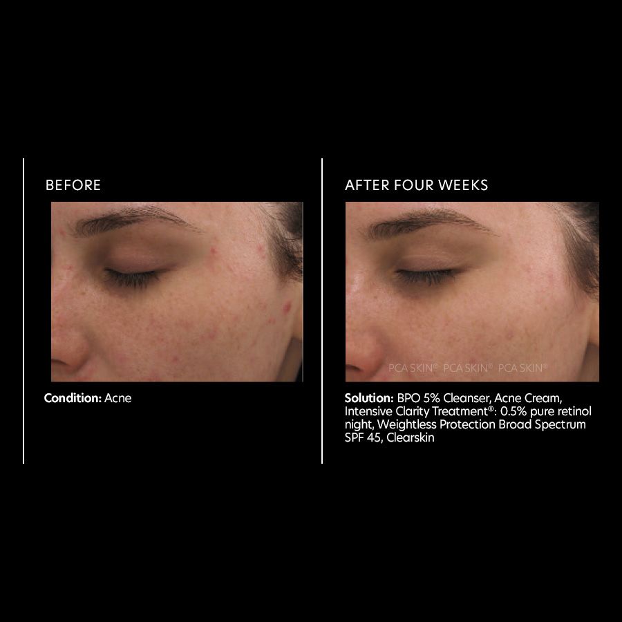 PCA Skin Intensive Clarity Treatment®: 0.5% pure retinol